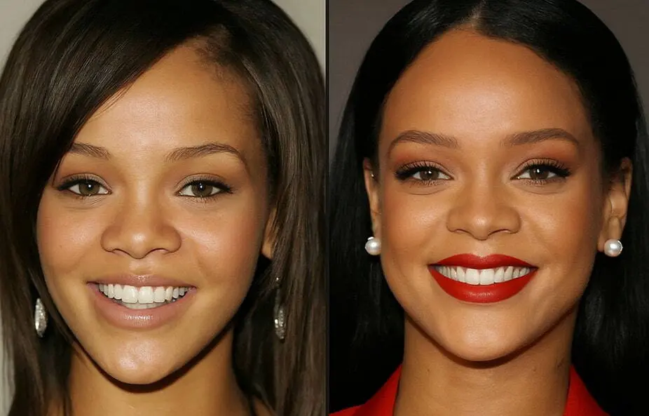 Rihanna after dental work